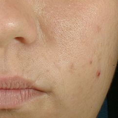  Serum Kiểm Soát Bã Nhờn, Ngăn Ngừa Mụn Blemish + Age Defense Skinceuticals 