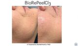  Peel Tái Tạo Da TCA BioRePeelCl3 