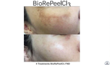  Peel Tái Tạo Da TCA BioRePeelCl3 