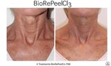  Peel Tái Tạo Da TCA BioRePeelCl3 