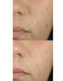  Serum Kiểm Soát Bã Nhờn, Ngăn Ngừa Mụn Blemish + Age Defense Skinceuticals 