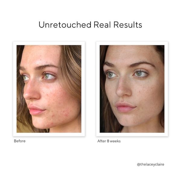  Serum Trị Sẹo Rỗ Và Thâm Mụn InvisiScar Treament Murad 