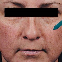  Serum Vitamin C Chống Oxy Hoá Da Hỗn Hợp Pholoretin CF Skinceuticals 