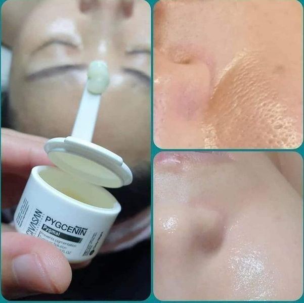 Civasan Pygmal Professional Peel - Kem loại nám tập trung