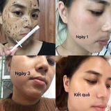  Set Liệu Trình Thay Da Sinh Học Bqcell Derma Skin Peeling Hàn Quốc [Mới 2021] 