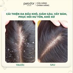 Dầu gội giảm gàu PURA D'OR Scalp Therapy Shampoo 473ml