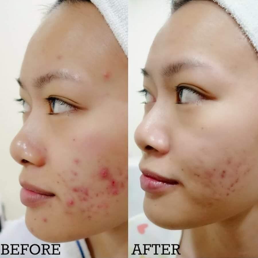 Kem Trị Mụn Phục Hồi Da Medi-Peel Centella Mezzo Cream 30ml