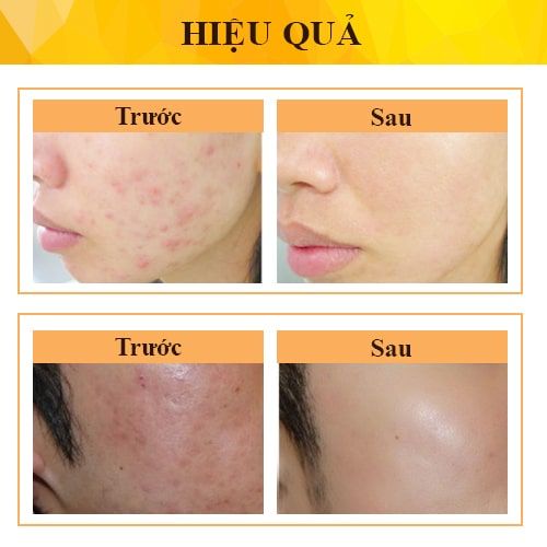 Kem Acne DermaX Derma Gel Hỗ Trợ Giảm Mụn, Giảm Thâm