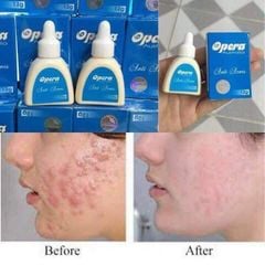 Kem Mụn Hiệu Quả Opera Anti Acnes 12gr