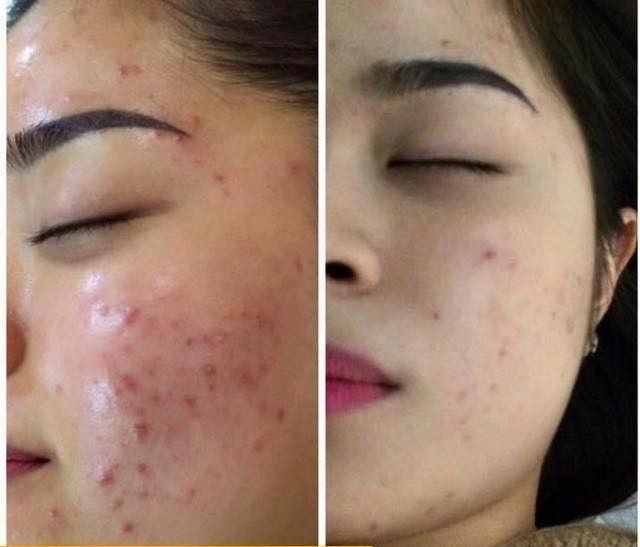 Kem mặt giảm mụn SVR Active Gel Sebiaclear 40ml- dạng gel và kem
