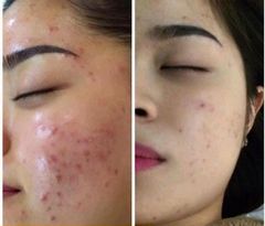 Kem mặt giảm mụn SVR Active Gel Sebiaclear 40ml- dạng gel và kem
