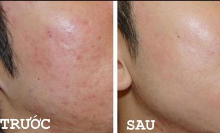 Kem mặt giảm mụn SVR Active Gel Sebiaclear 40ml- dạng gel và kem