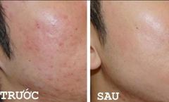 Kem mặt giảm mụn SVR Active Gel Sebiaclear 40ml- dạng gel và kem