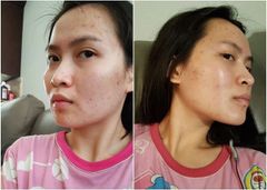 Kem mặt giảm mụn SVR Active Gel Sebiaclear 40ml- dạng gel và kem