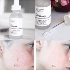 Serum Tinh chất Trị Mụn Và Giảm Thâm The Ordinary Niacinamide 10% + Zinc 1% 30ml