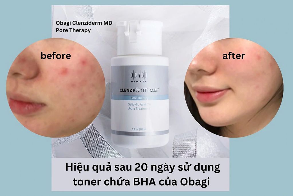Dung Dịch Trị Mụn Obagi Salicylic Acid 2% Ance Treatment 148ml