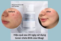 Dung Dịch Trị Mụn Obagi Salicylic Acid 2% Ance Treatment 148ml