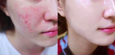 Kem Trị Mụn Phục Hồi Da Medi-Peel Centella Mezzo Cream 30ml
