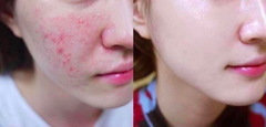 Kem Trị Mụn Phục Hồi Da Medi-Peel Centella Mezzo Cream 30ml