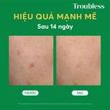  Gel chấm mụn Troubless chăm sóc mụn kháng khuẩn, ngừa mụn trứng cá 