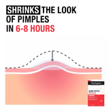 Miếng Dán Mụn Neutrogena Hydrocolloid – Cho Da Nhạy Cảm, 30 Miếng Nhiều Kích Cỡ