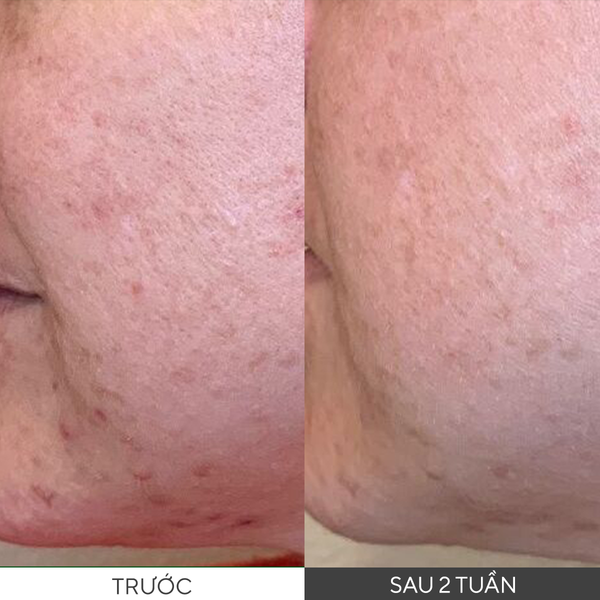 ACNE - Dung dịch tẩy tế bào chết hóa học, thông thoáng lỗ chân lông Murad Daily Clarifying Peel 95ml
