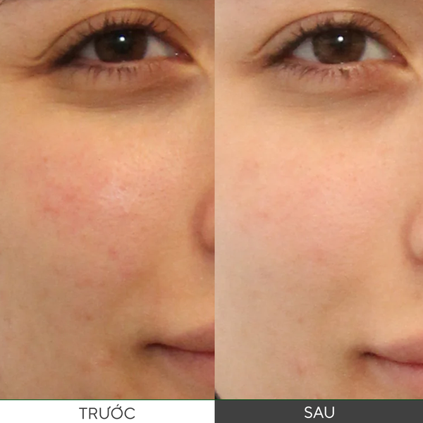 ACNE - Gel rửa mặt cho da dầu mụn Murad Clarifying Cleanser 200ml