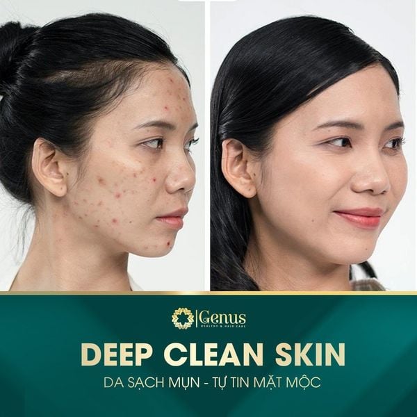  Chăm sóc và Điều trị mụn Genus Spa 