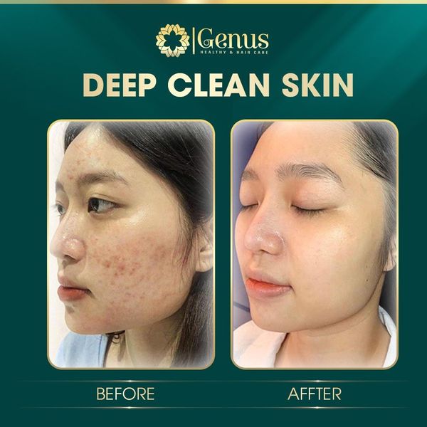  Chăm sóc và Điều trị mụn Genus Spa 