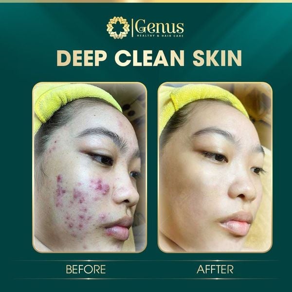  Chăm sóc và Điều trị mụn Genus Spa 