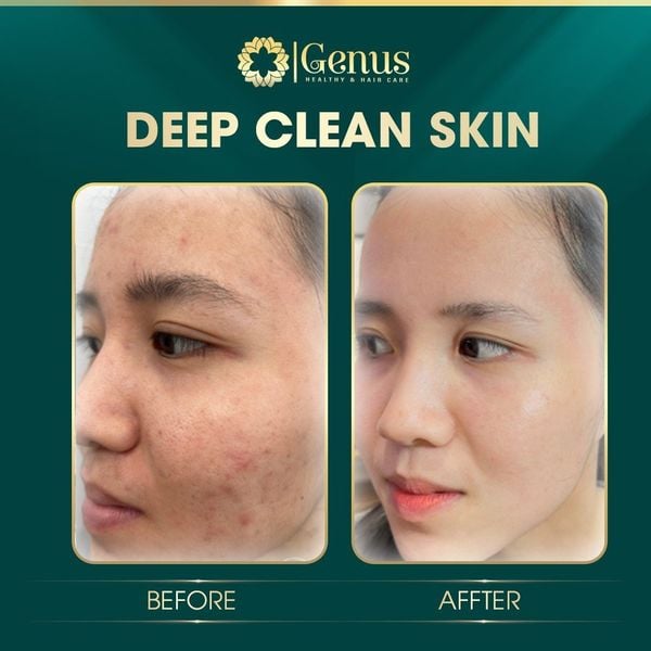  Chăm sóc và Điều trị mụn Genus Spa 