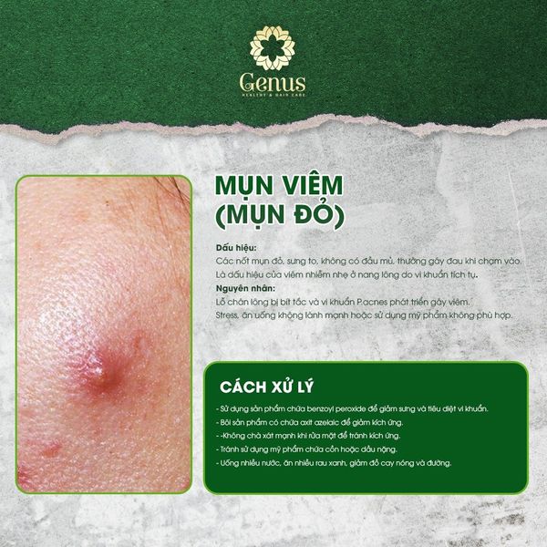  Chăm sóc và Điều trị mụn Genus Spa 