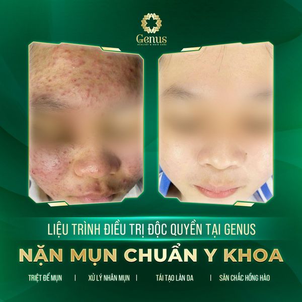  Chăm sóc và Điều trị mụn Genus Spa 