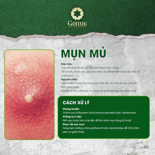  Chăm sóc và Điều trị mụn Genus Spa 