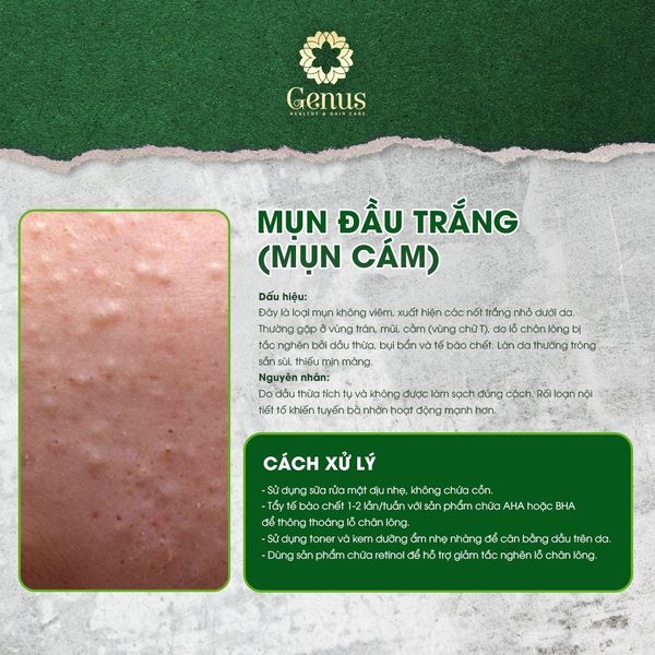  Chăm sóc và Điều trị mụn Genus Spa 