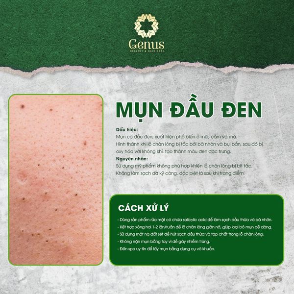  Chăm sóc và Điều trị mụn Genus Spa 