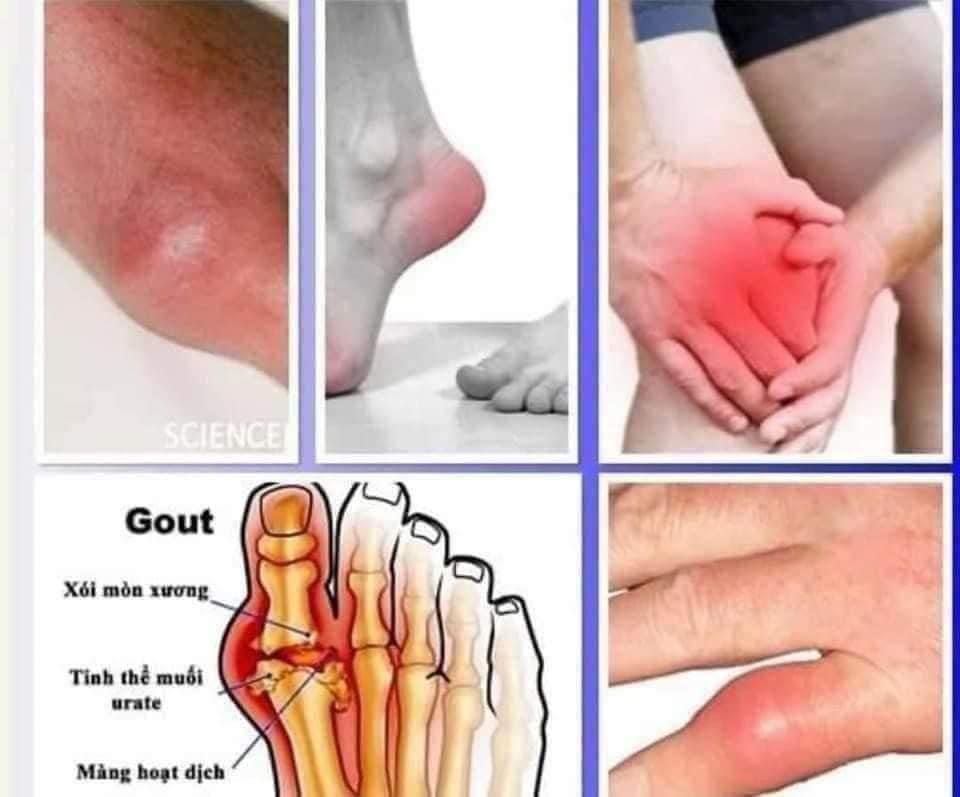  THUỐC ĐẶC TRỊ BỆNH GÚT 