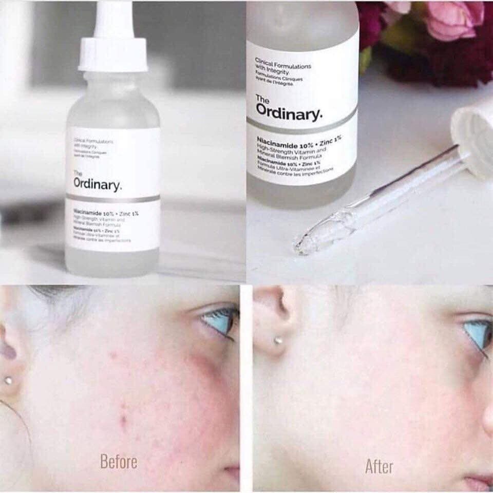 Serum Tinh Chất Trị Mụn Thâm The Ordinary Niacinamide 10% + Zinc 1% - 30ml