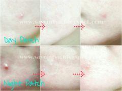 Miếng Dán Mụn Derma Angel Dùng Ban Ngày & Đêm Acne Patch For Day & Night (6 miếng ngày + 6 miếng đêm)