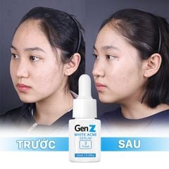 Serum Giảm Mụn Oriskin GenZ White Acne Serum Loại Bỏ Các Loại Mụn Viêm, Trứng Cá Và Mụn Đầu Đen 15ml