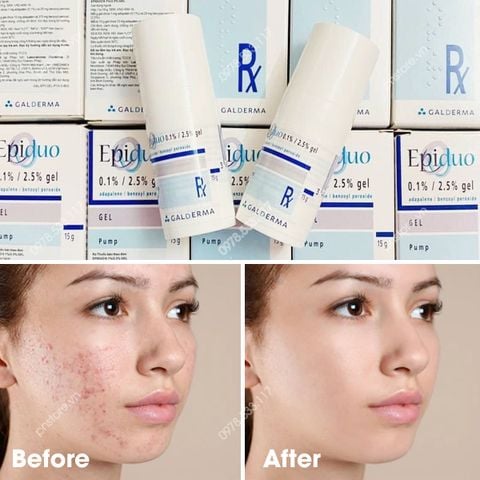 Kem trị mụn viêm, mụn mủ, mụn trứng cá Galderma Epiduo Gel 15g