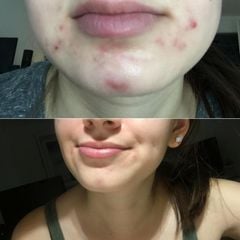 Kem trị mụn viêm, mụn mủ, mụn trứng cá Galderma Epiduo Gel 15g