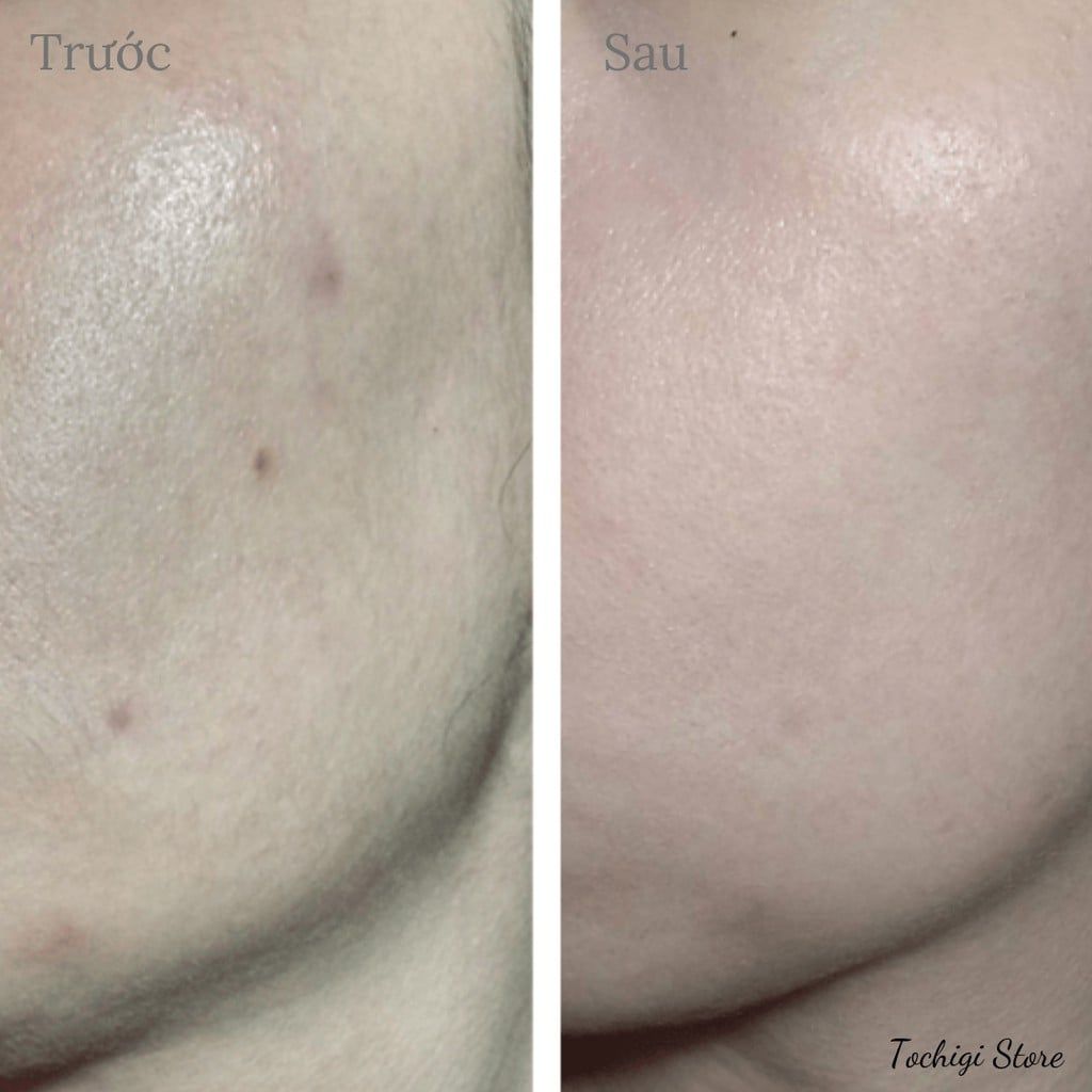 Serum Melano CC Vitamin C, E ngừa mụn và dưỡng trắng