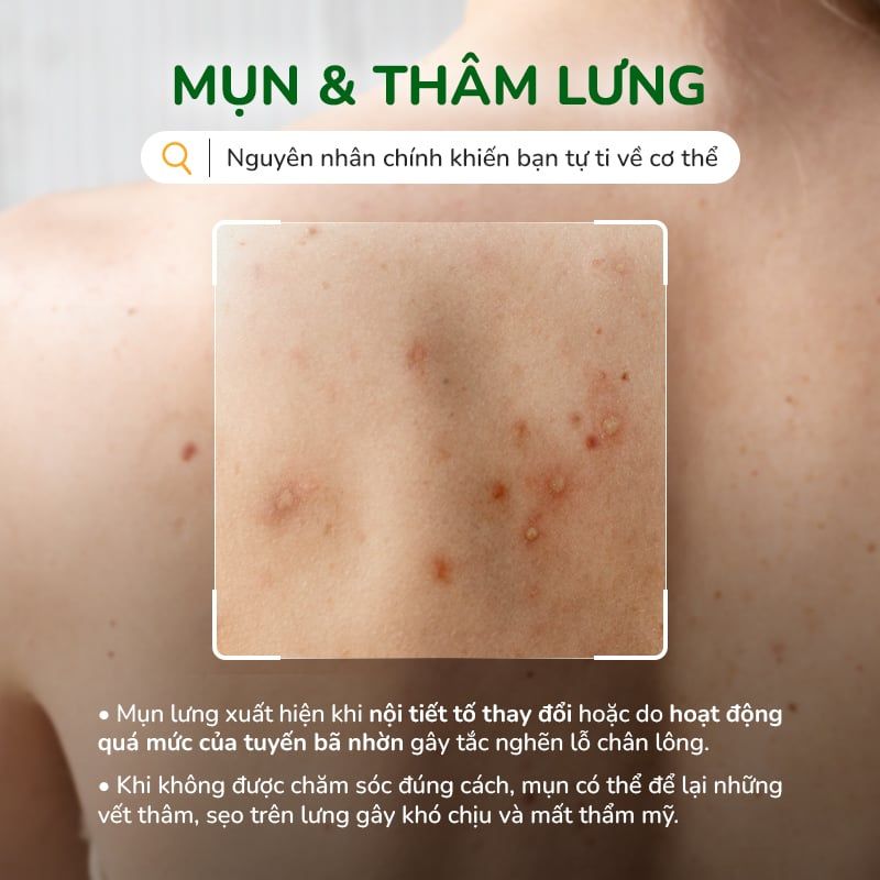 Xịt giảm mụn lưng, giảm thâm mụn, sạch mụn mờ thâm giảm viêm NeoAcnes 100ml