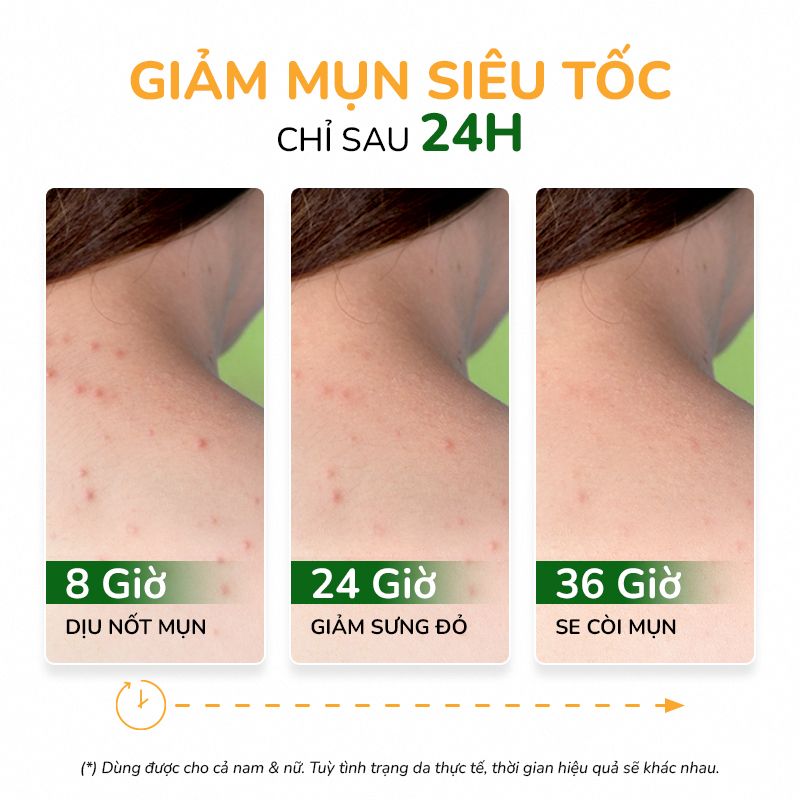Xịt giảm mụn lưng, giảm thâm mụn, sạch mụn mờ thâm giảm viêm NeoAcnes 100ml