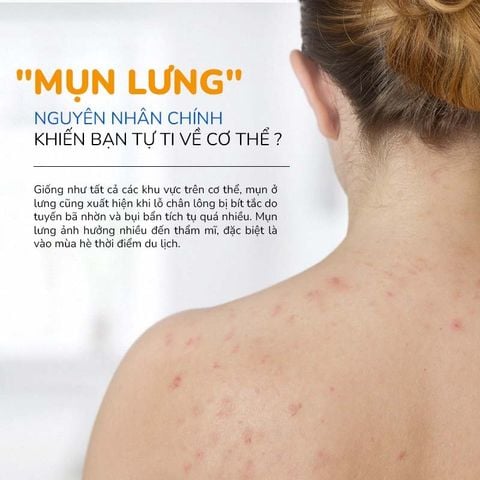 Xà Phòng Giảm Mụn Thâm Lưng Mông Nghệ Curcumin & Tràm Trà NeoAcnes (75g)