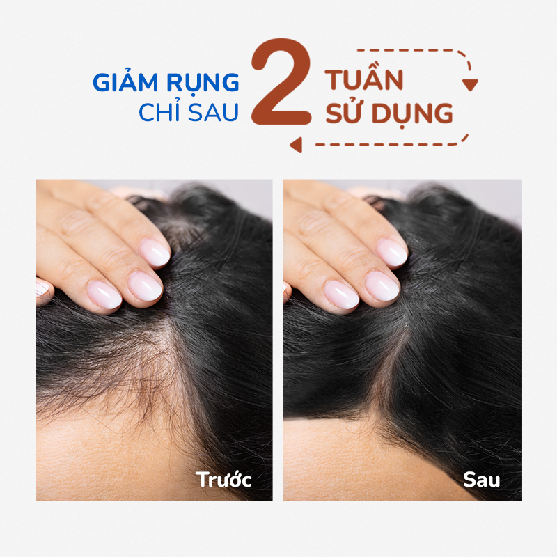 Rụng tóc nhiều ở nam có sao không Cách khắc phục thế nào  Nhà thuốc FPT  Long Châu