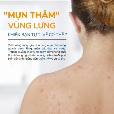 Xà Phòng Giảm Mụn Thâm Lưng, Làm Dịu Lỗ Chân Lông Neem Oil & Dầu Dừa Neo Acnes (75g)