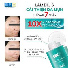 Hadalabo Tinh chất Acne Care Calming Serum 30ml