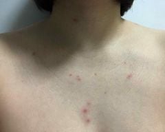 Xà Phòng Trị Mụn Lưng Pelican For Back Medicated Soap 135g